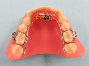 3D_Skelatal_Expander_Fixed_Dental_Appliance-300x225